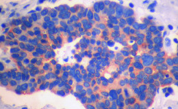 Рак легких немелкоклеточный