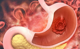 Рак желудка