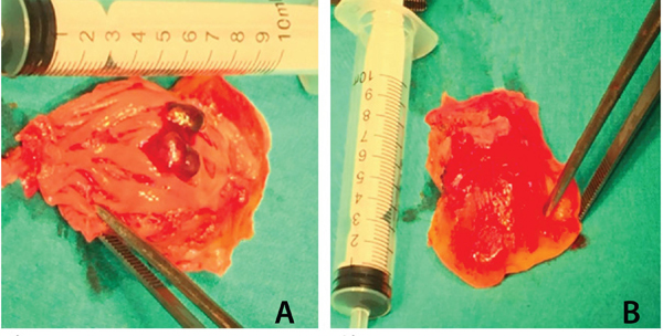 Ангиосаркома