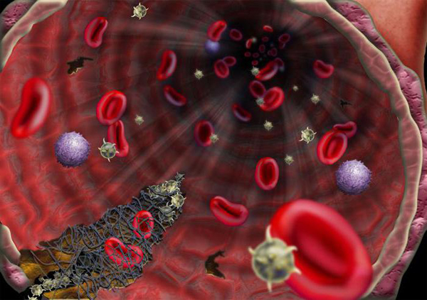 Гемобластоз