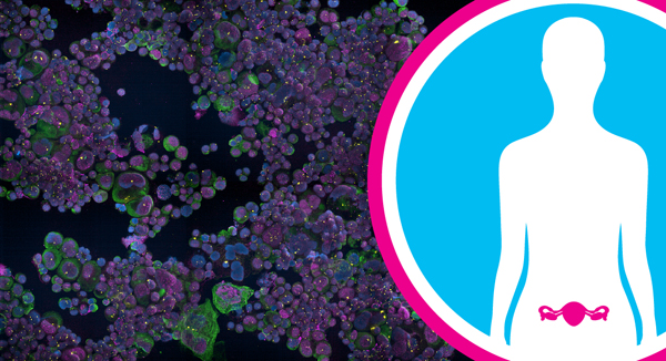 Рак яичников