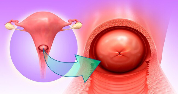 Рак шейки матки
