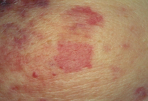 Ангиосаркома