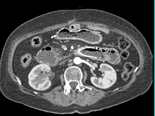 Рак двенадцатиперстной кишки