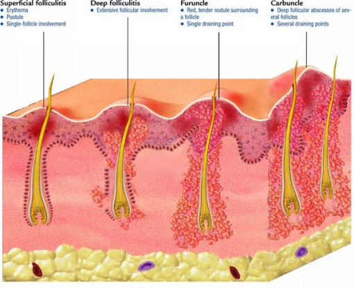 Фурункулез