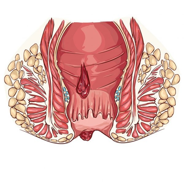 Геморрой