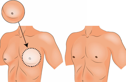 Гинекомастия