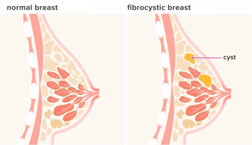 Кисты молочной железы
