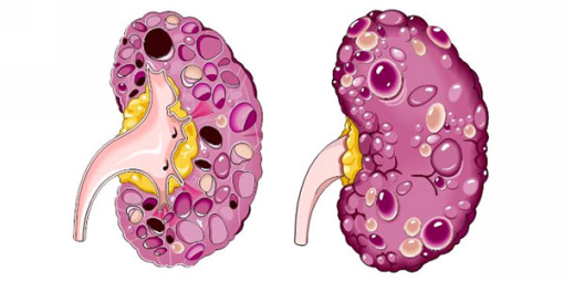 Кисты почек