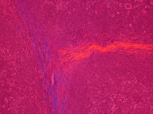 Лимфома Ходжкина