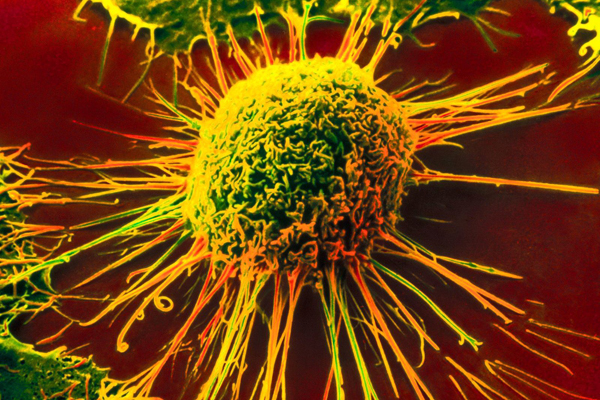 Гемобластоз