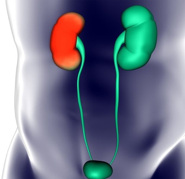 Пиелонефрит