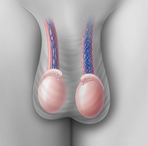 Варикоцеле