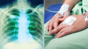 Химиотерапия при лимфомах