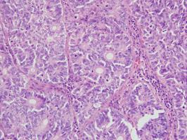 Рак легких немелкоклеточный