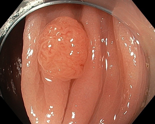 Подготовка к качественному исследованию толстой кишки — колоноскопии