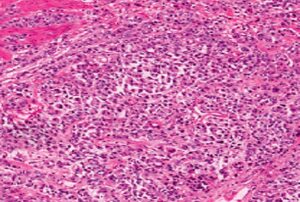 Рак желудка