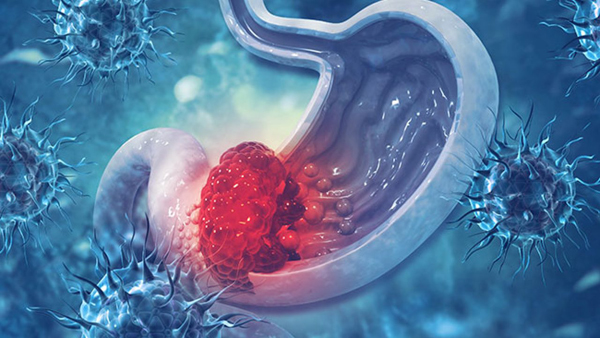 Лечение рака желудка