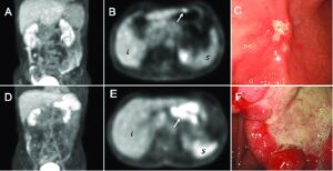 Рак желудка