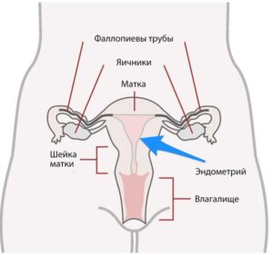 Рак эндометрия (рак тела матки) - симптомы и лечение