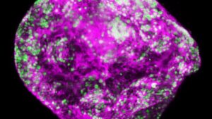 Рак желудка