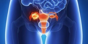 Химиотерапия при раке яичников