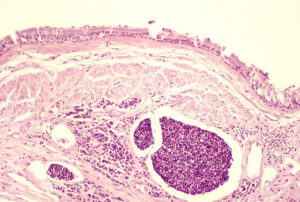 Рак легких немелкоклеточный
