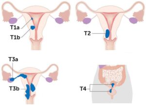 Рак эндометрия (рак тела матки) - симптомы и лечение