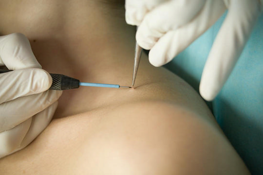 Удаление папиллом