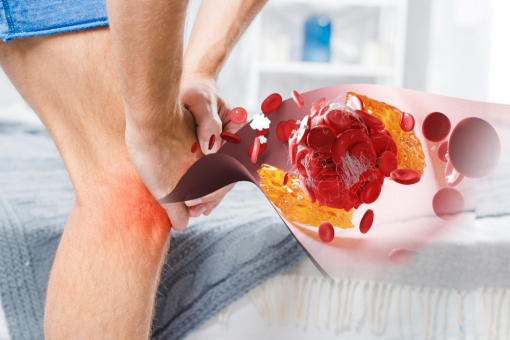 Саркома мягких тканей