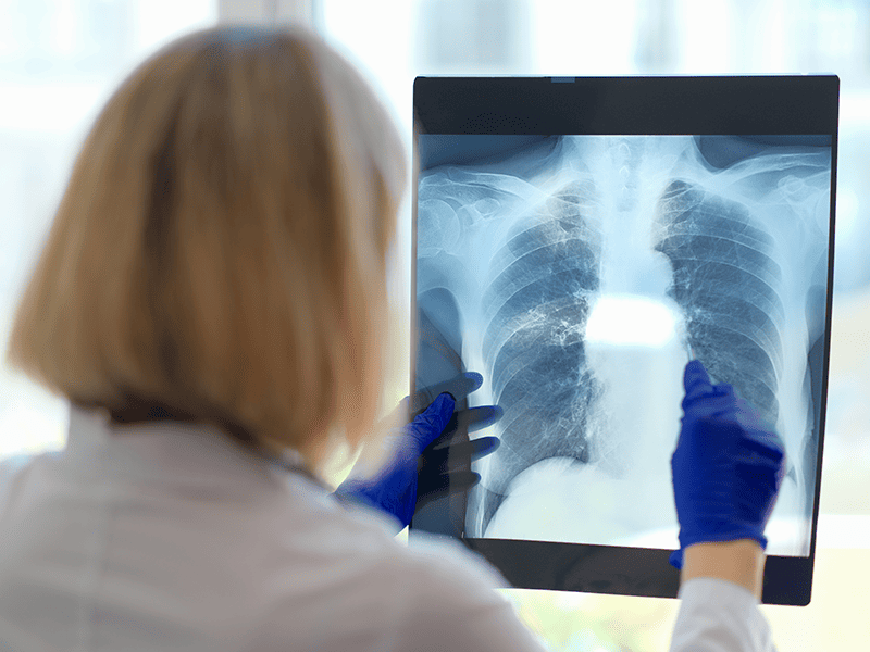 Мелкоклеточный рак легких-4