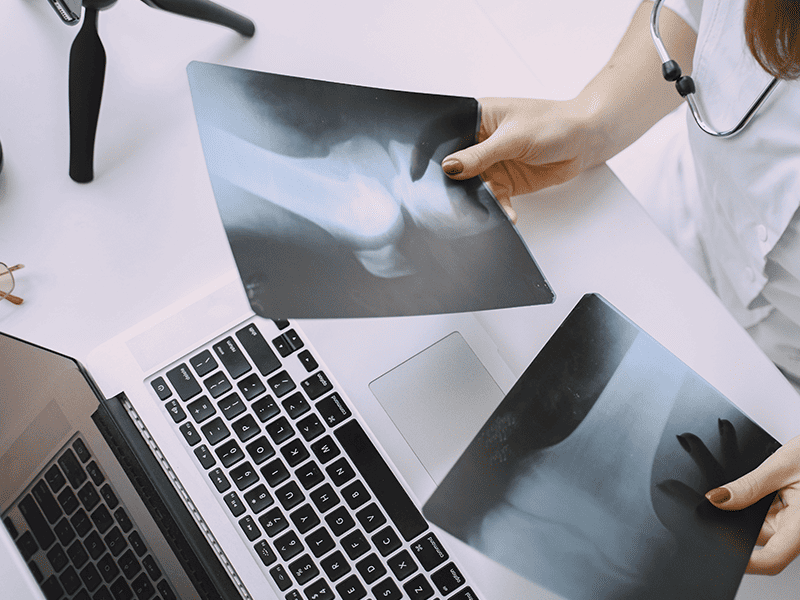 Хондросаркома-3