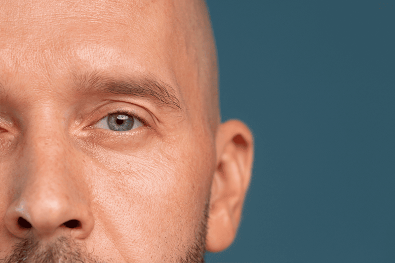 Меланома глаза-2 Меланома глаза-2