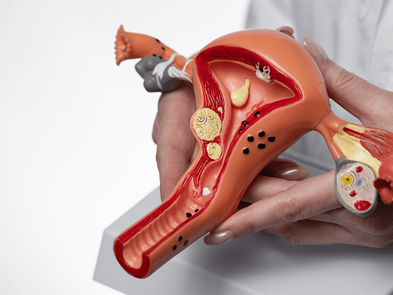 Аденокарцинома матки-1