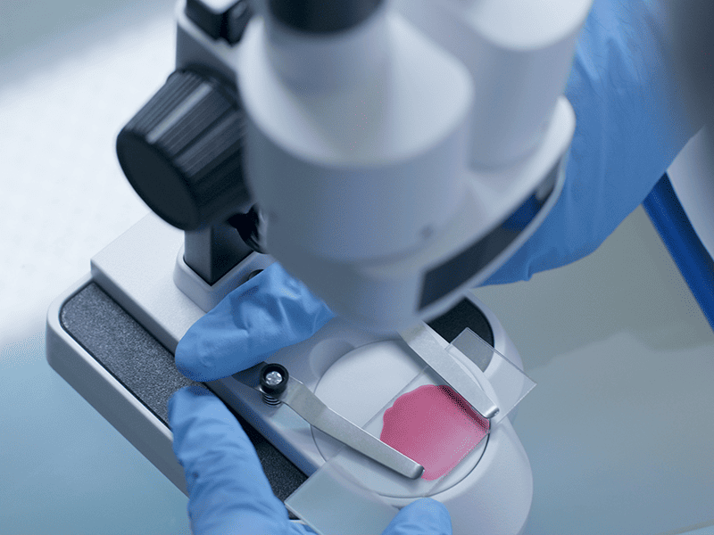 Рак полости рта-6