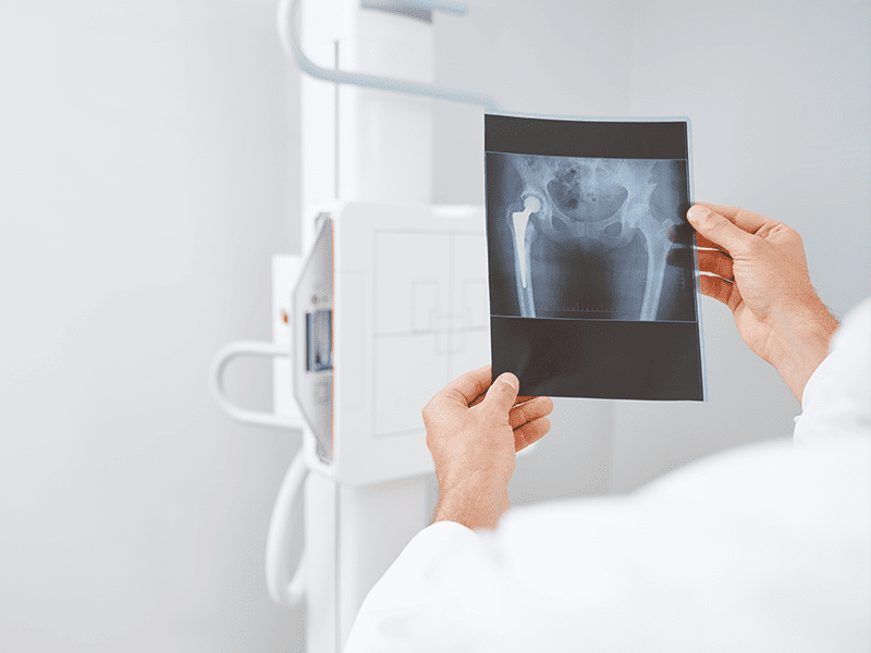 Аденокарцинома матки-4