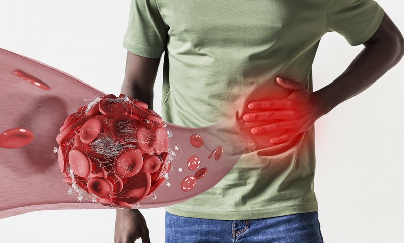 Распространение рака на брюшину-1